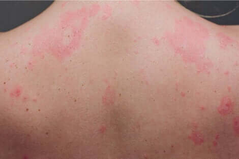 Chronische urticaria op de rug
