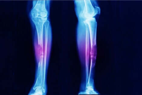 Een röntgenfoto van een paar benen