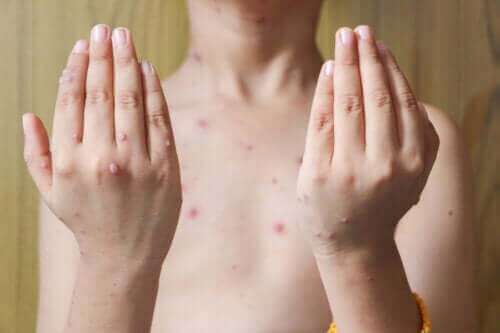 De behandeling van herpes zoster bij kinderen