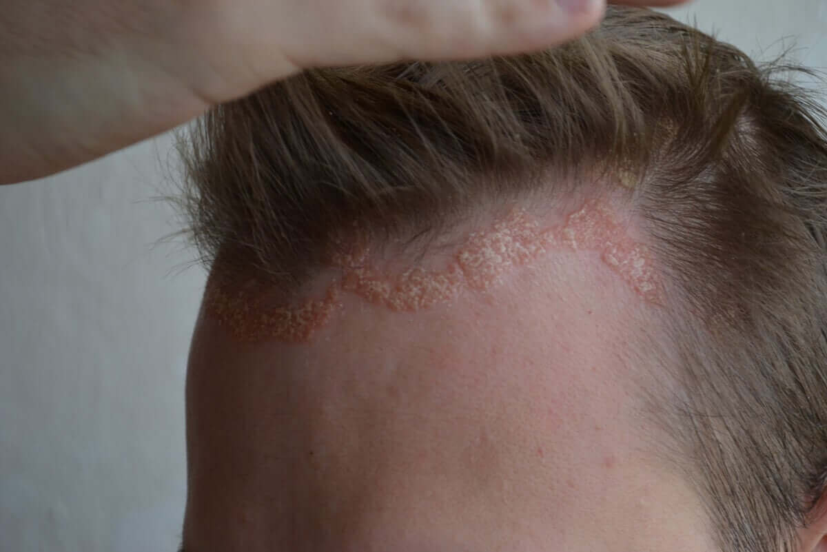 Hoofdhuid met psoriasis