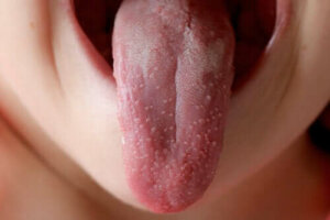 Is roodvonk besmettelijk? Alles wat je moet weten