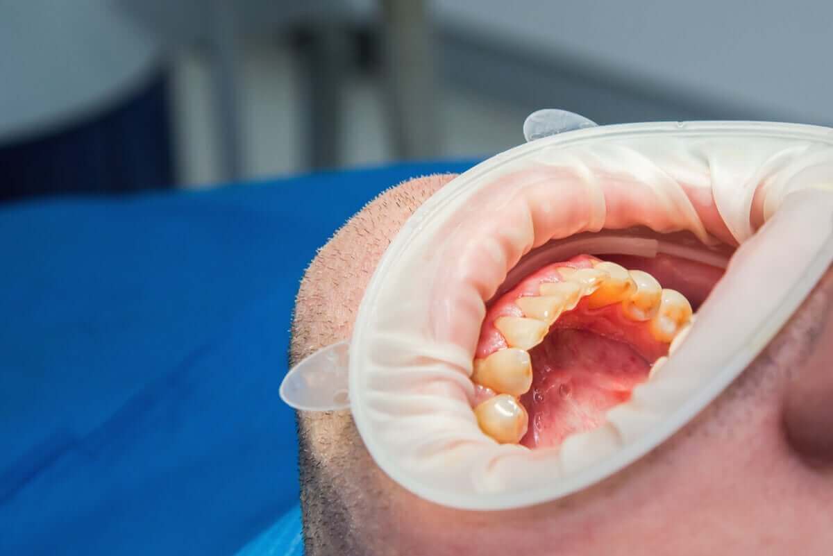 Appelazijn kan brandwondjes in de mond veroorzaken