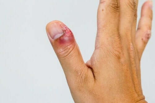 Ontstoken nagelriem van een duim