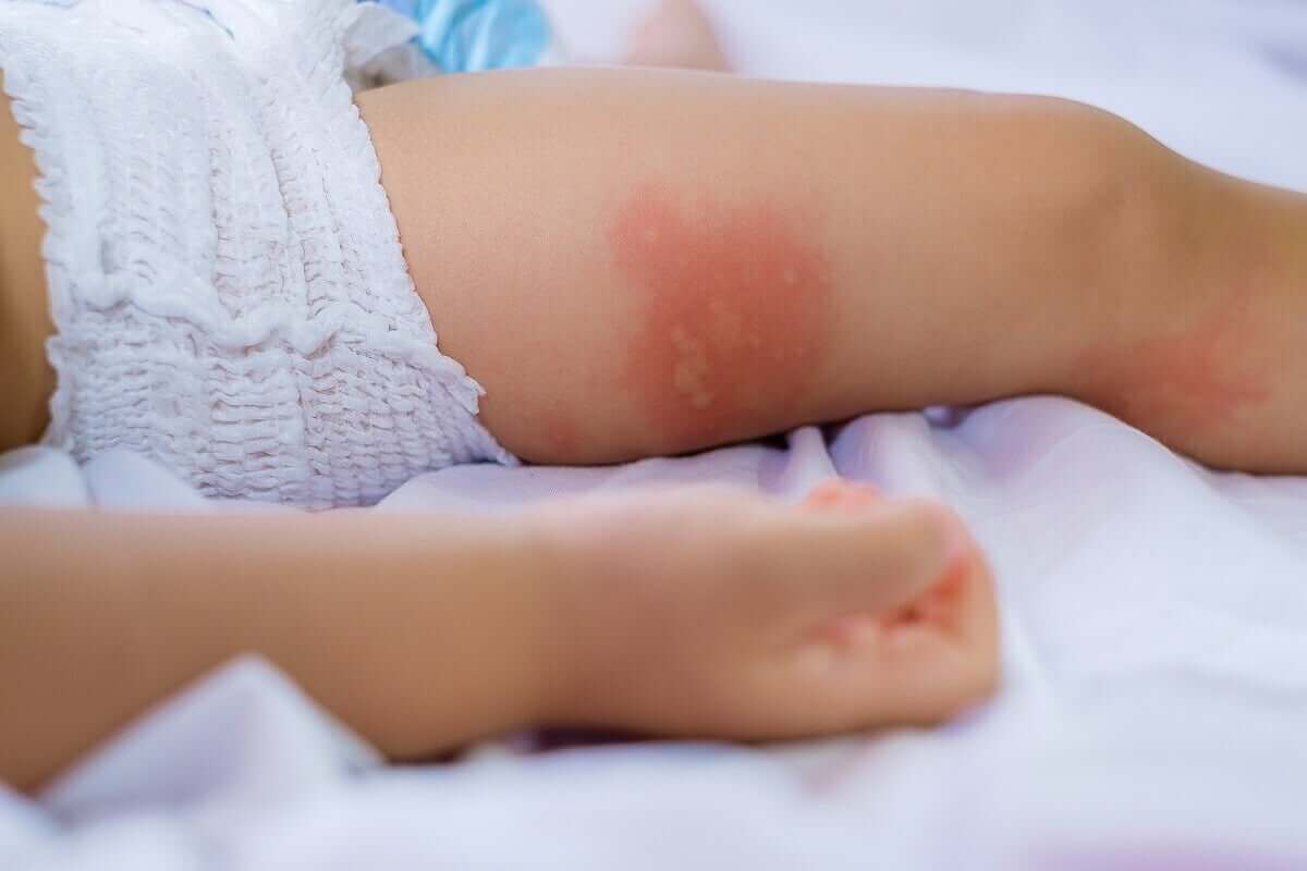 Baby met uitslag