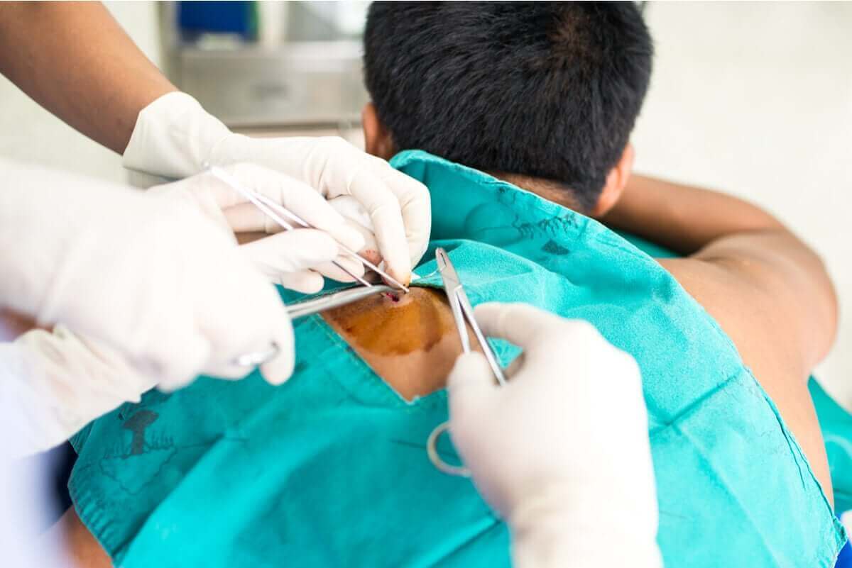 Biopsie op de rug