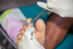 Gangreen: soorten symptomen en behandelingen