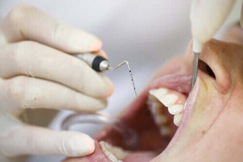 Pyorroe: een problematische tandvleesaandoening