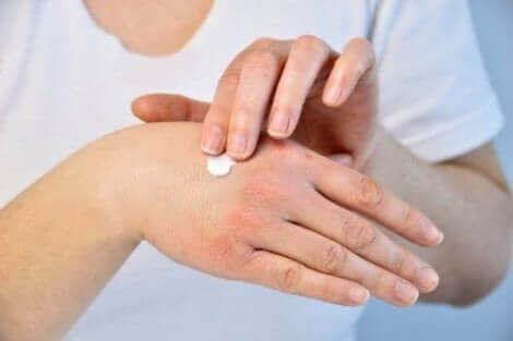 Persoon die handcrème na een bijensteek toepast