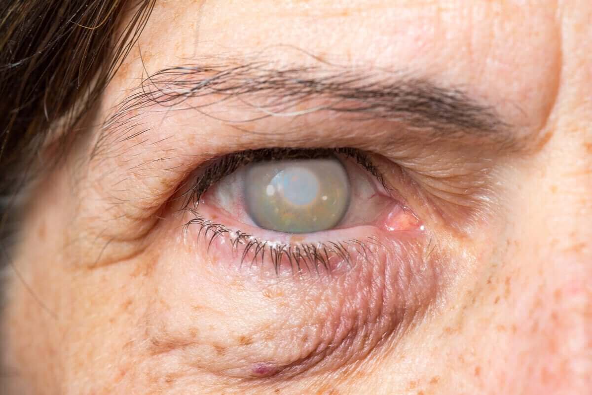 Oog met staar
