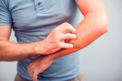 Symptomen van tungiasis