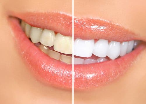 Tanden voor en na een behandeling