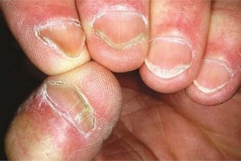 Nagels van iemand met de ziekte van Hallopeau