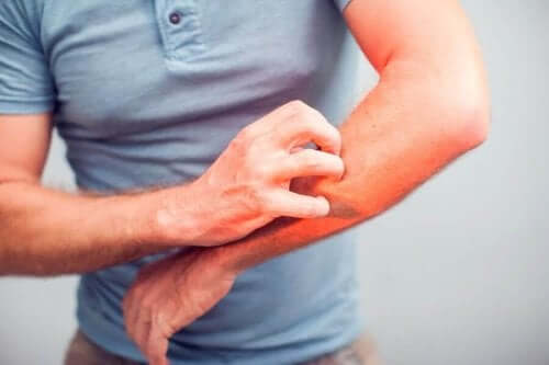 5 natuurlijke remedies om jeuk te verlichten