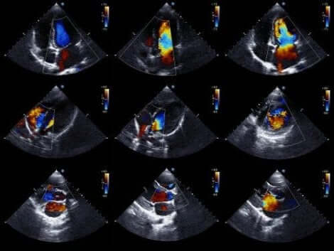 Afbeelding van een echocardiogram