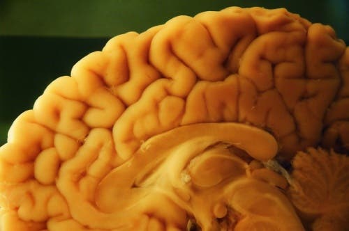Een autopsie van de hersenen
