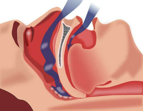 Gewoonten om je te helpen omgaan met slaapapneu
