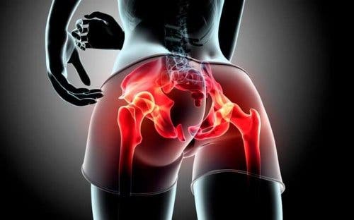 Wat is gluteale tendinopathie