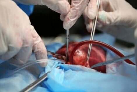 Artsen die een harttransplantatie uitvoeren