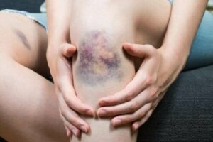 Wat veroorzaakt oppervlakkige tromboflebitis?