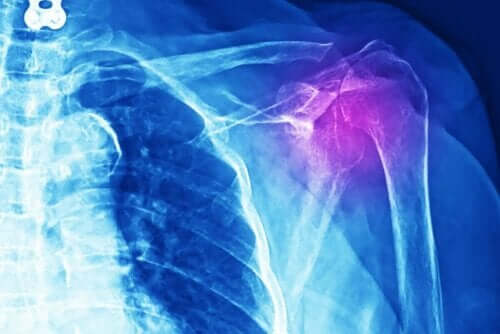 Een röntgenfoto van een schoudergewricht