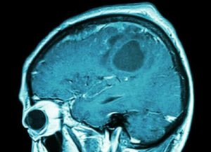 Komt er binnenkort een hersenkankervaccin?