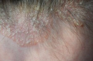 Psoriasis op de hoofdhuid: symptomen en behandeling