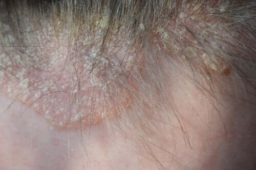 psoriasis hoofdhuid dieet vörös foltok az okán a nők fotóján