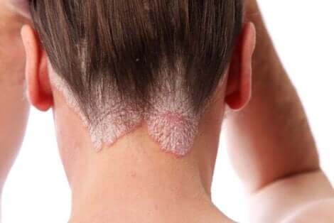 Vrouw met psoriasis op de hoofdhuid