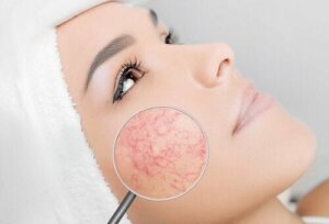 6 dingen die je moet vermijden als je rosacea hebt