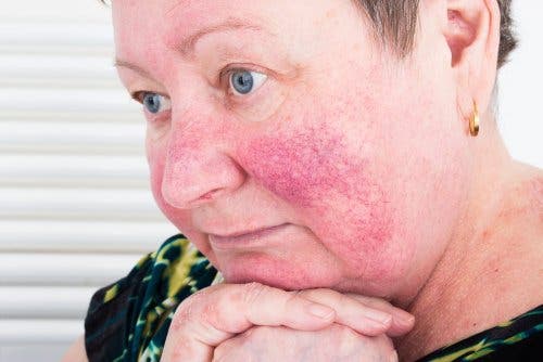 Wang met rosacea