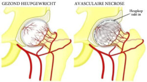 Avasculaire necrose van de heup