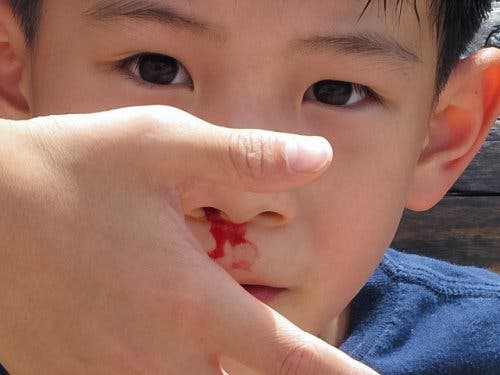 Hoe een bloedneus bij kinderen te behandelen