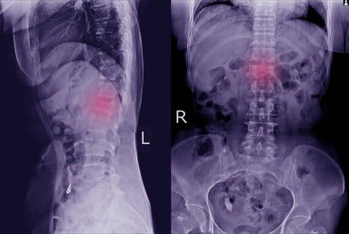 Een röntgenfoto kan nodig zijn om de verplaatste wervel te identificeren