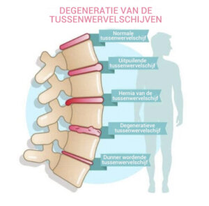Symptomen van degeneratieve schijfziekte