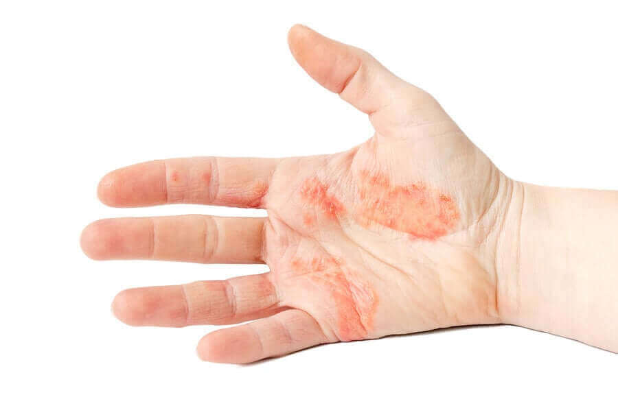 Handpalm met eczeem