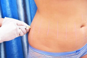 Wat is lipotherapie en waar dient het voor?