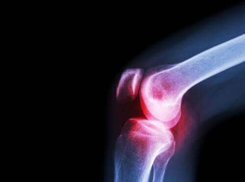 Oorzaken, symptomen en behandeling van septische artritis