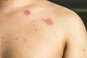 Beschrijving en kenmerken van pityriasis versicolor