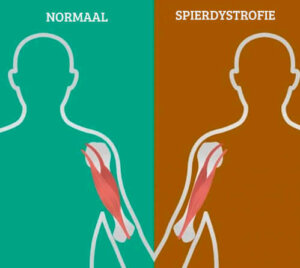 Symptomen van neuromusculaire aandoeningen
