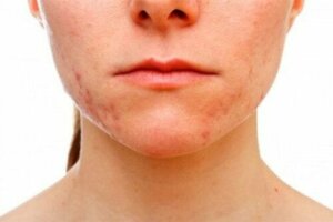 Acne conglobata: oorzaken en symptomen