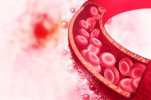 Fibromusculaire dysplasie: diagnose en behandeling