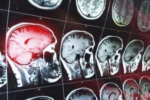Patiënten kunnen confabuleren na het oplopen van hersenletsel