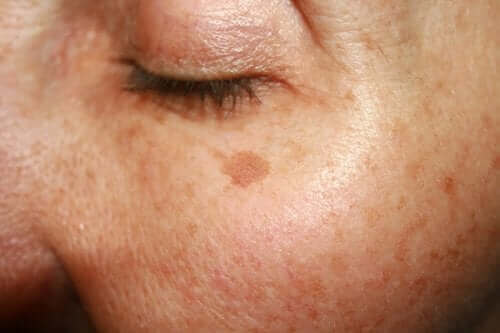 Melasma is een van de huidaandoeningen waar we het over hebben