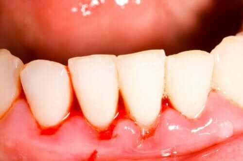 Ontstoken tandvlees is een van de symptomen van een loopgraafmond