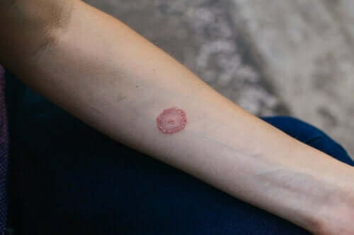 Cirkelvormige, rode verkleuring van de huid op de arm door een schimmelinfectie