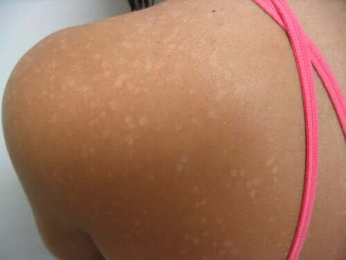 Tinea versicolor of rugvlekken