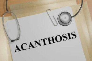 De oorzaken van acanthosis nigricans