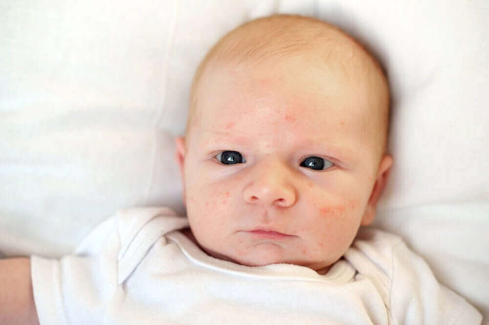 Baby acne