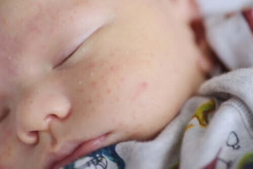 Huidproblemen bij baby’s zoals berg en babyacne behandelen