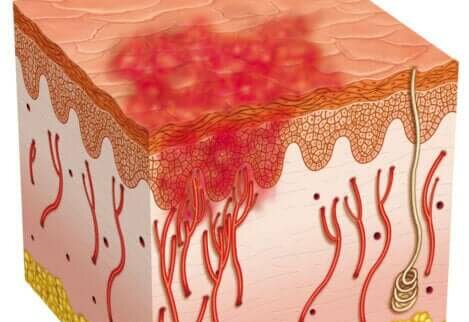 Een schematische weergave van een huidzweer